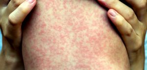 Measles rash from not having a vaccine.