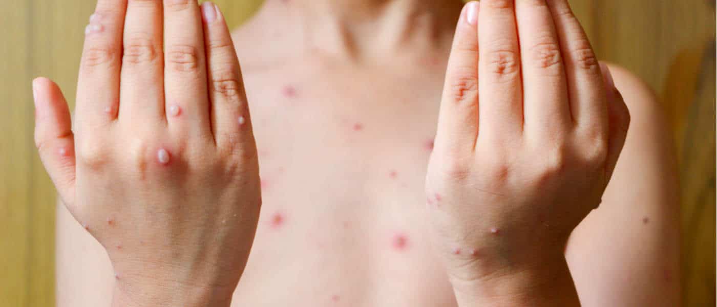 chicken pox pictures in adults